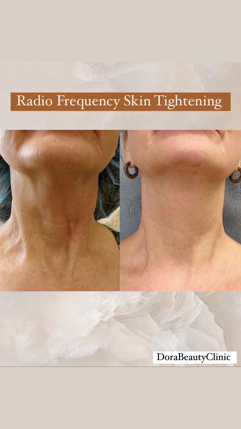 Radio Frequency Skin Tightening Before and After at Dora Beauty Clinic, London