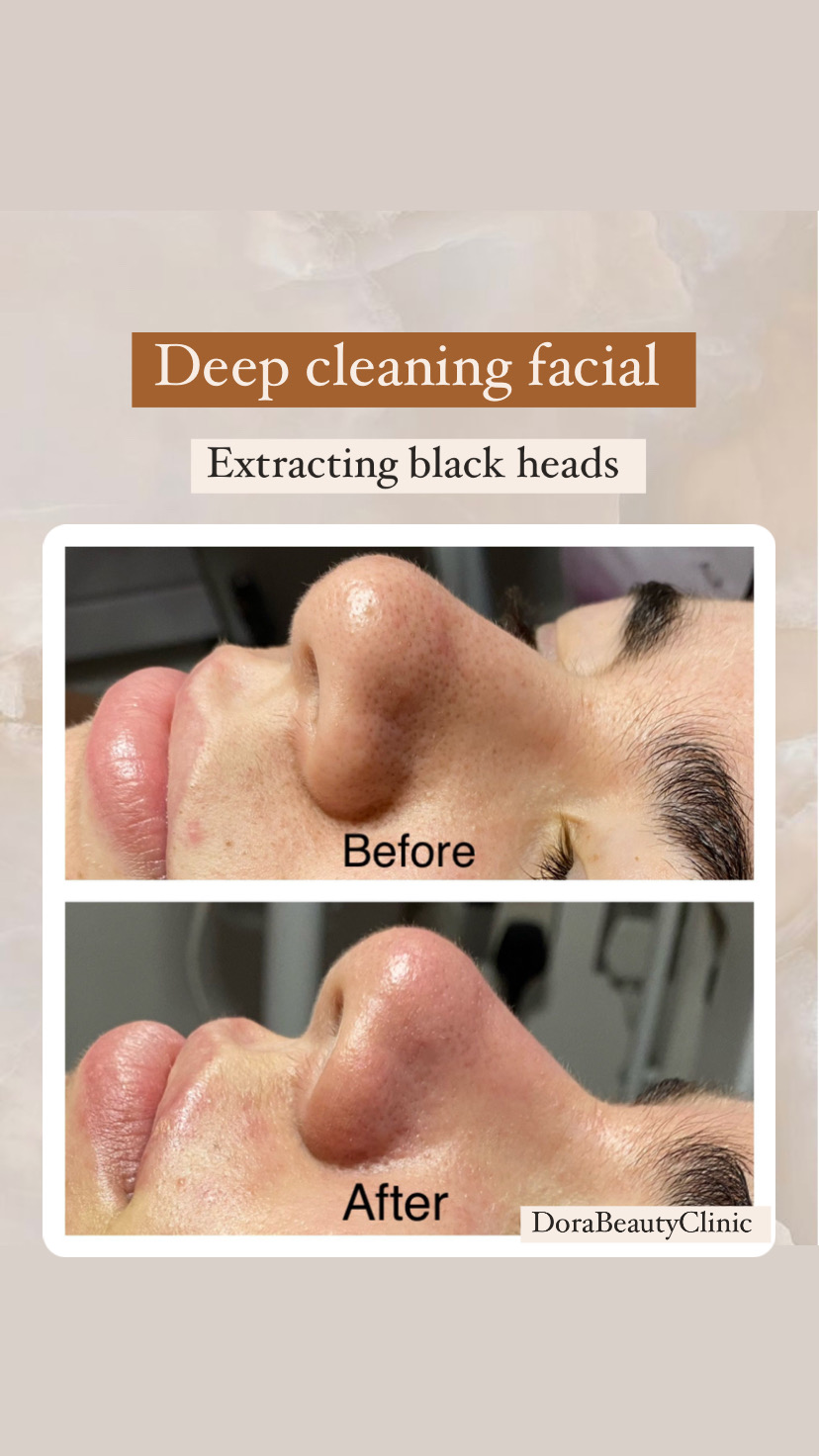 Deep Cleaning Facial and Blackhead Extraction Before and After at Dora Beauty Clinic, London