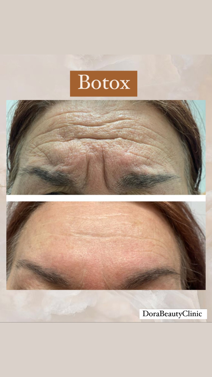 Botox Treatment for Forehead Wrinkles Before and After at Dora Beauty Clinic, London